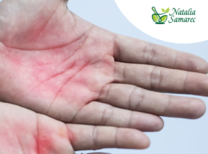 skórne objawy chorej wątroby